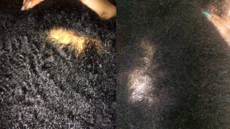 Perte de cheveux chez les femmes : 4 raisons pour lesquelles vous devez consulter un professionnel de la santé