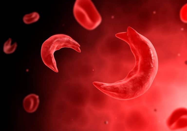 Drépanocytose : un nouveau traitement que toute personne atteinte doit connaître