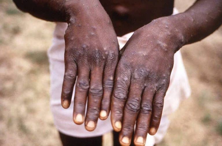 Côte d'Ivoire/La variole de singe ‘’mpox’’ fait déjà des victimes : un bilan préoccupant